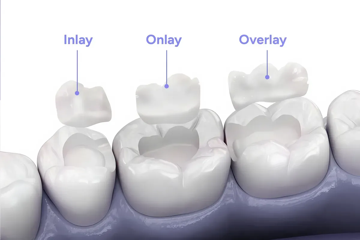 Imed Inlay Onlay Krunica Prikaz
