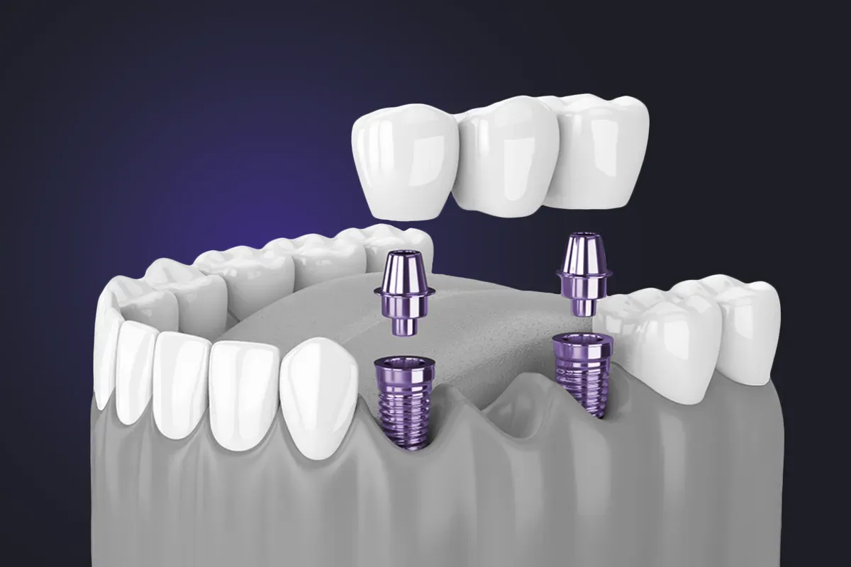Imed Segmentalni Most Na Implantatima