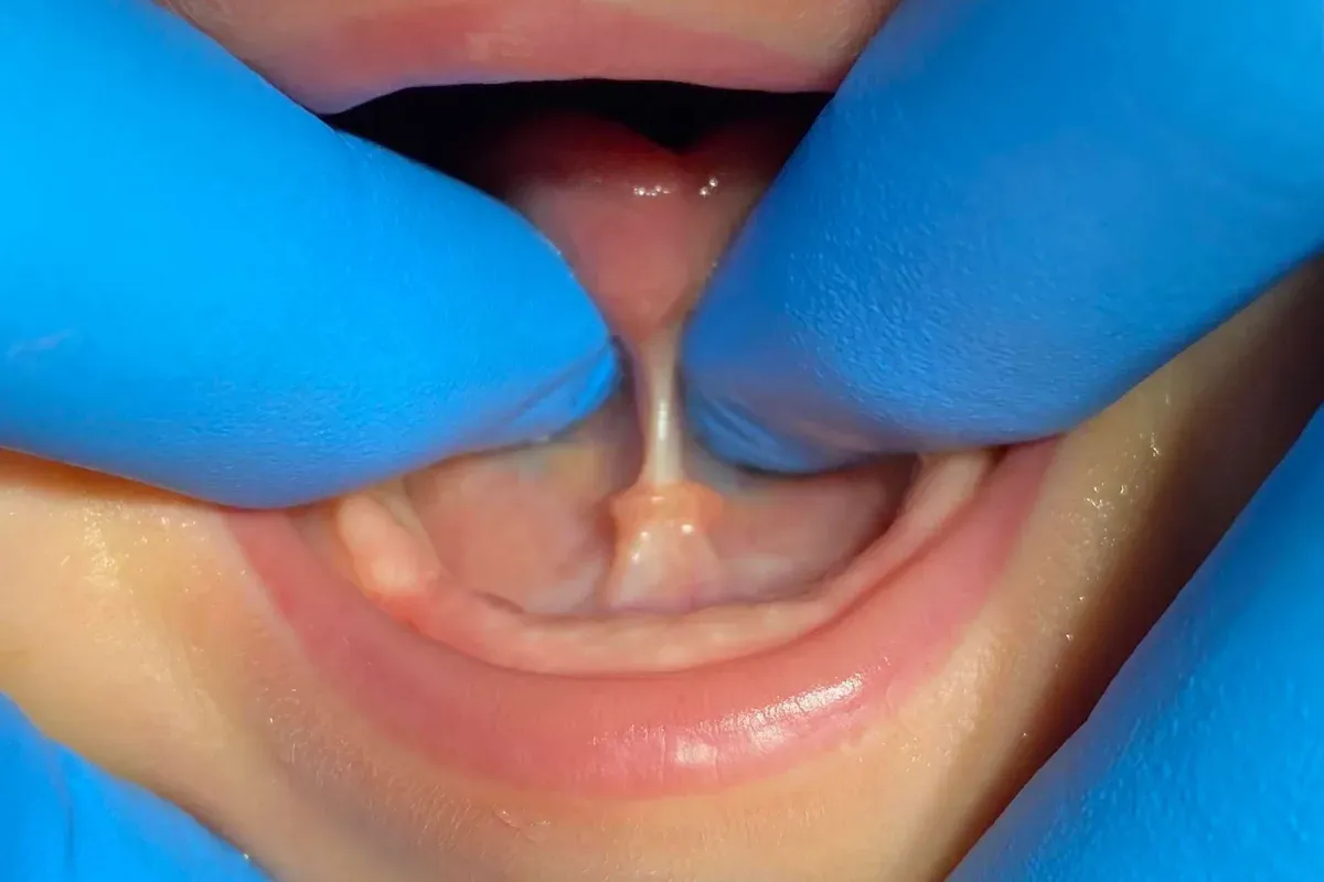 Imed Frenulum Jezika Dijete