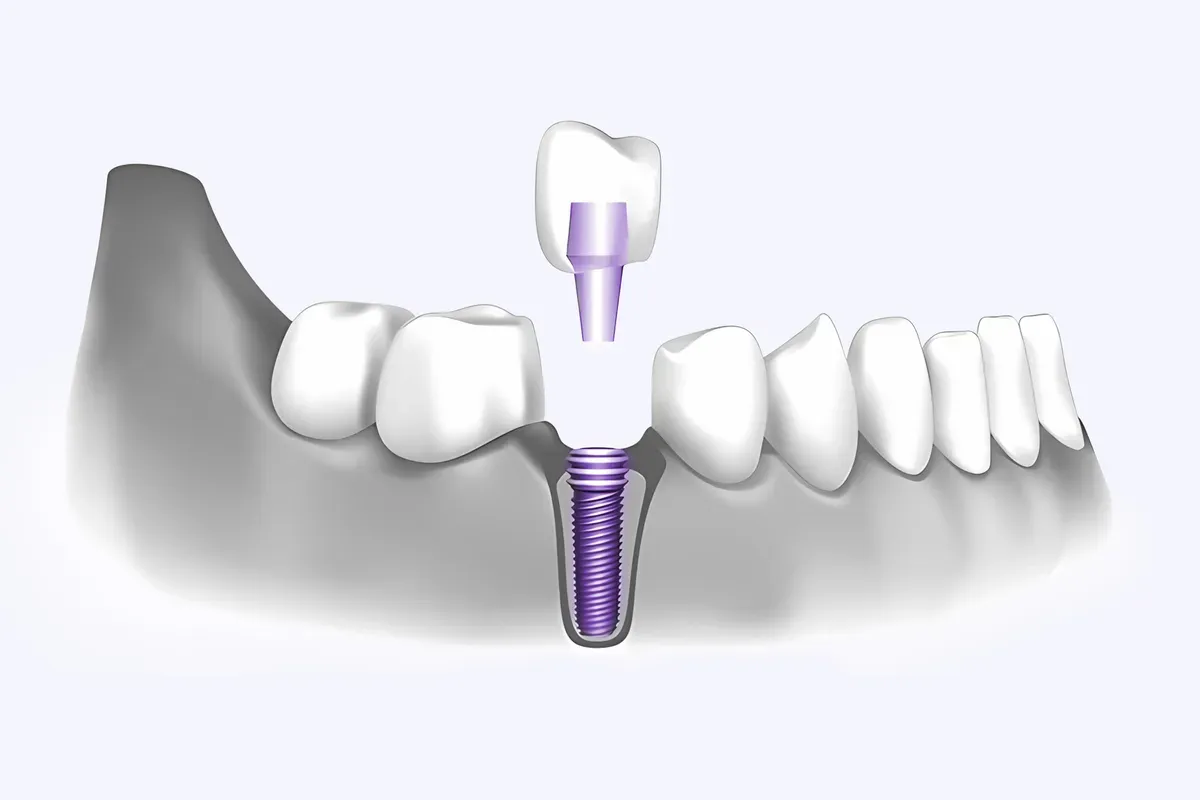 Imed Ugradnja Jednog Zubnog Implantata