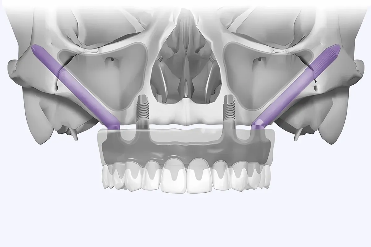 Imed Full Arch Zigomaticni Implantati Prikaz