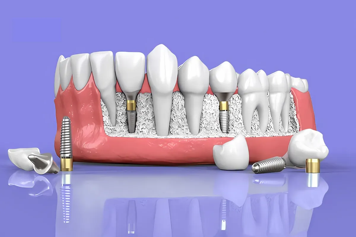 Imed Implantati Simulacija Vilice