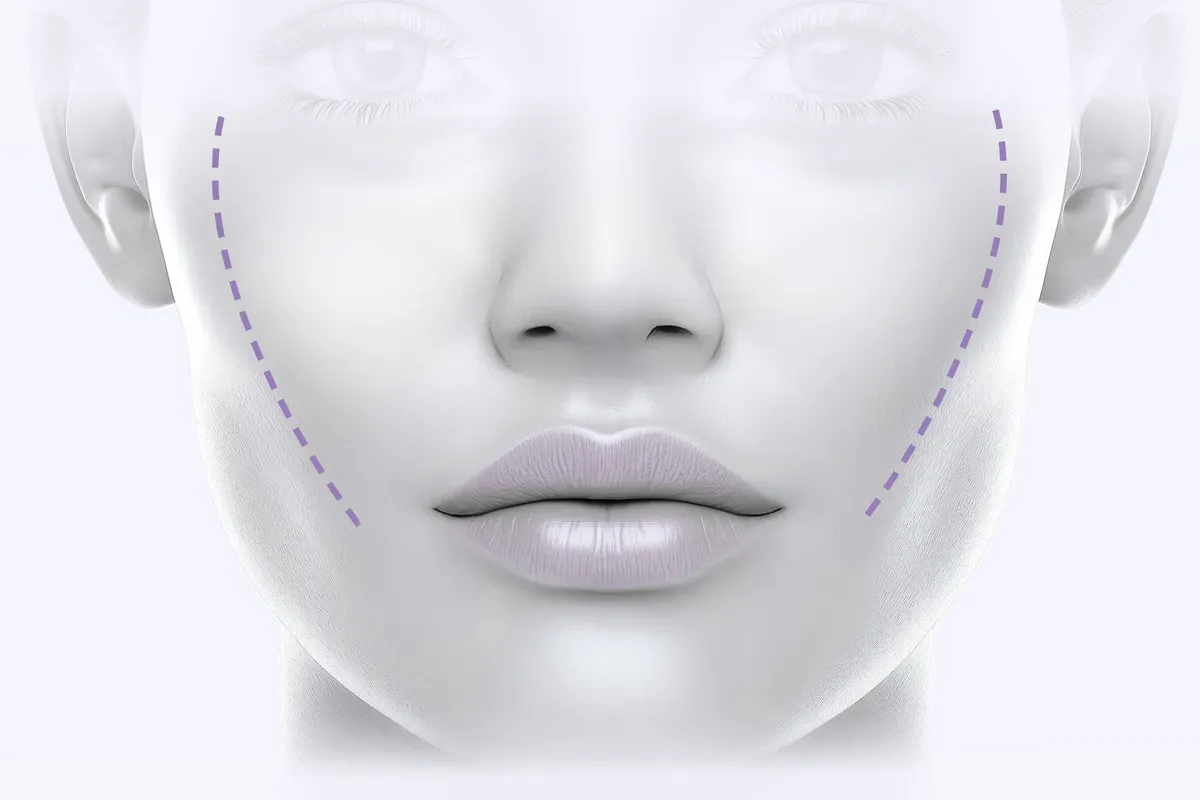 Imed Modificirani Facelift Linije Lica