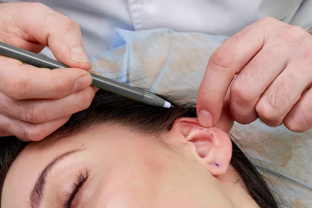 Priprema Za Otoplastiku Oznake